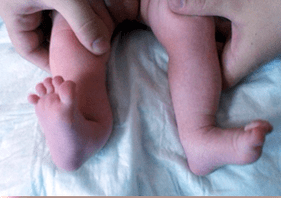 Deformation of valgus on children's symptoms
