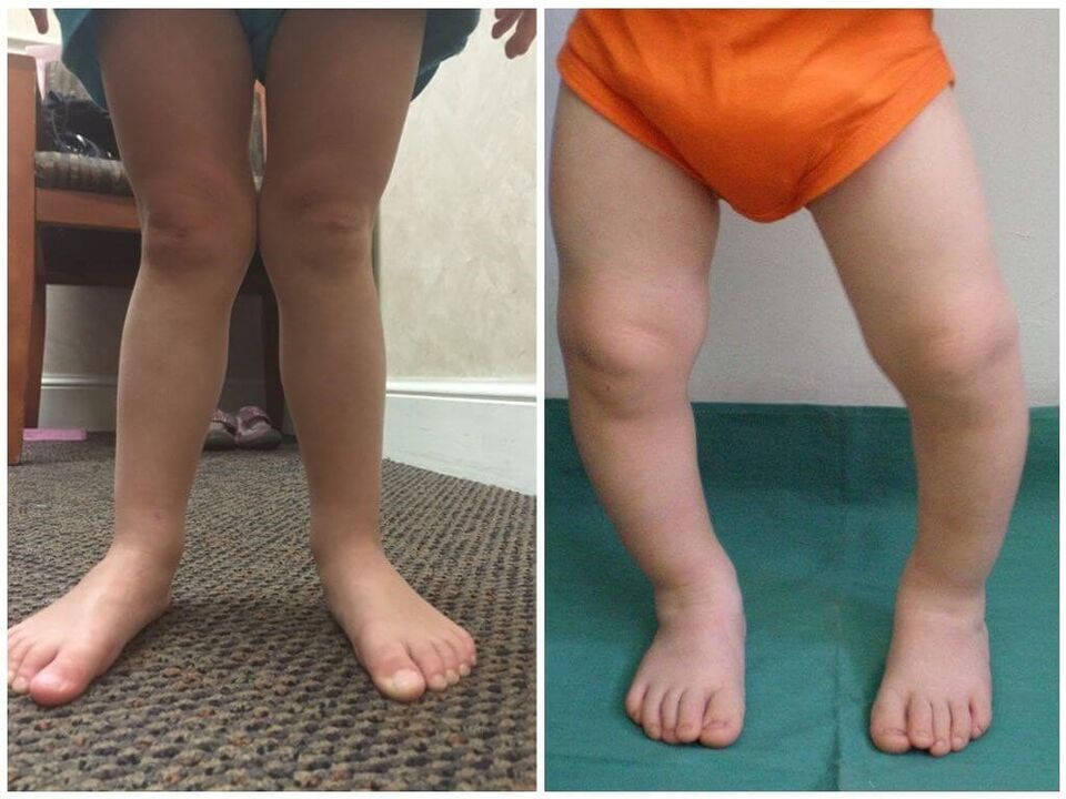 Valgus deformation on children causing