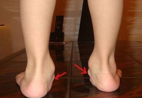 Valgus