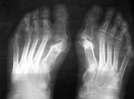 Hints for operations under the foot valgus
