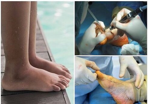 Small surgical treatment -small