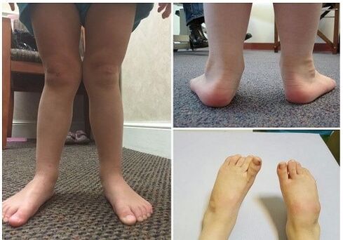 Valgus deformation on children