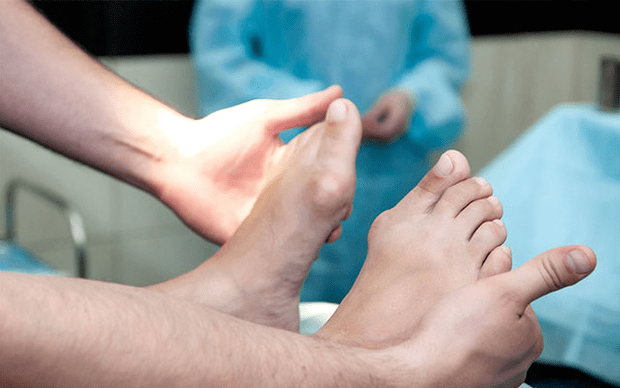Valgus foot deformation